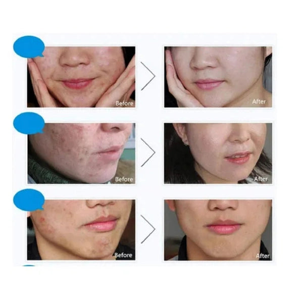 Bioaqua Pure Skin Removalof Acne